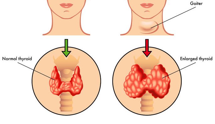 normal thyroid and thyroid with goiter