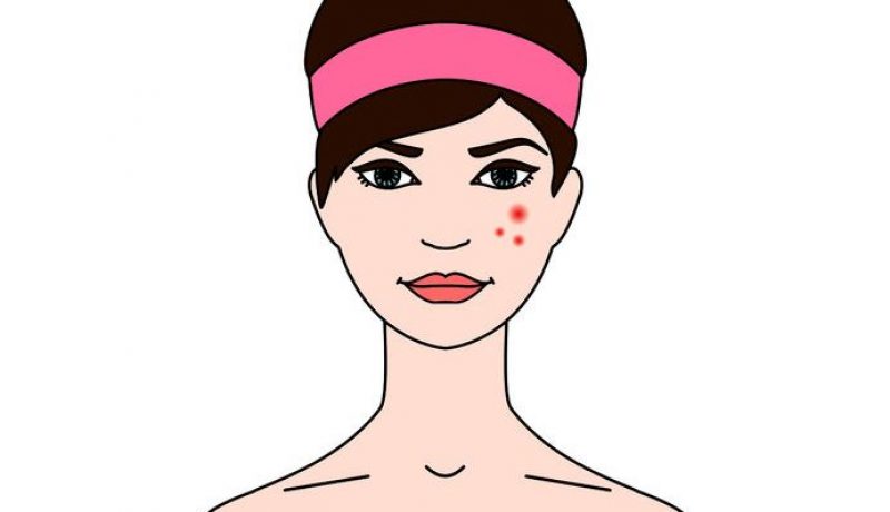 Can Thyroid Diseases Cause Acne?