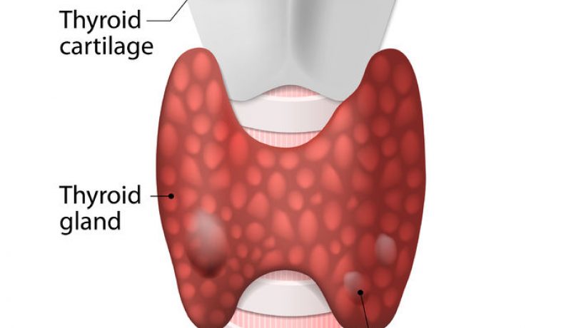 Thyroid Nodules Overview: What They Are, Symptoms, Causes, Diagnoses and Treatments