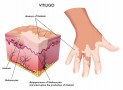 Is There A Connection Between Autoimmune Thyroid Diseases And Vitiligo?