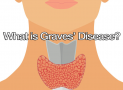 What is Graves’ Disease?