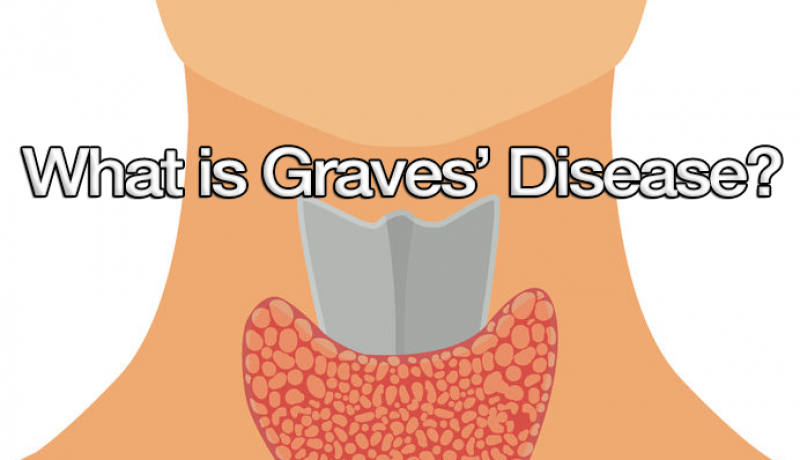 What is Graves’ Disease?